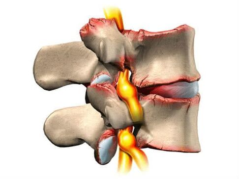lesións da columna vertebral por osteocondrose