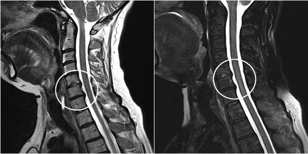 osteocondrose cervical na imaxe de resonancia magnética