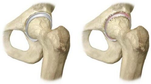 articulación da cadeira sa e afectada por artrose